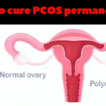 How to cure PCOS permanently?