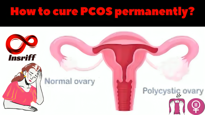 How to cure PCOS permanently?